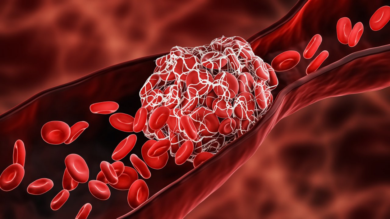 Oft bekommen Patienten im Krankenhaus etwa Blutverdünner - denn Covid-19 erhöht die Gefahr von Thrombosen.