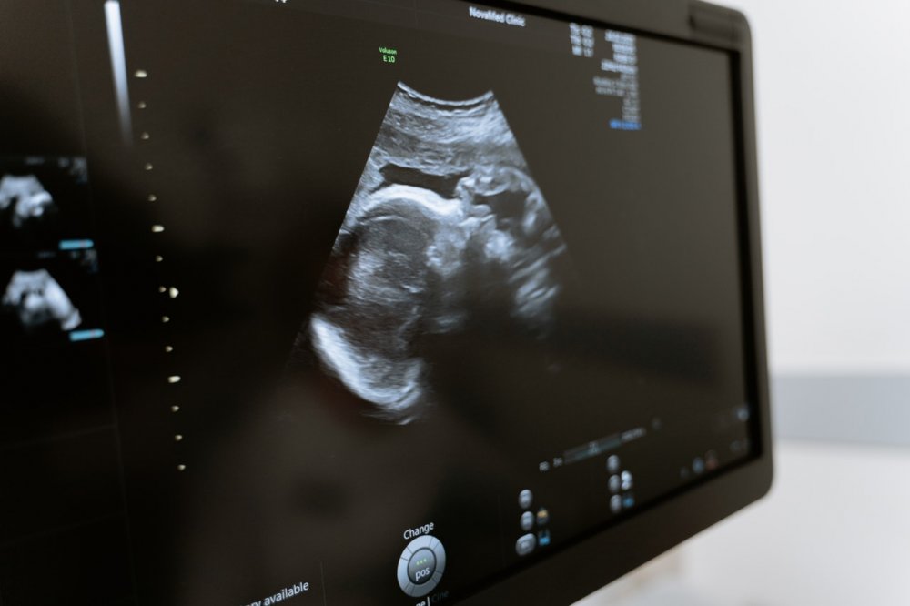 Ultraschall Schwangerschaft 
